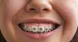 Straightening teeth? AI can help     